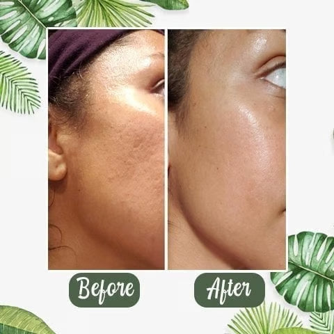 Eleroa ClearSkin Green Tea Stick – Visibly Clearer Skin in Just 7 Days