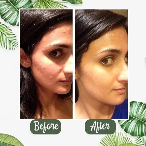 Eleroa ClearSkin Green Tea Stick – Visibly Clearer Skin in Just 7 Days